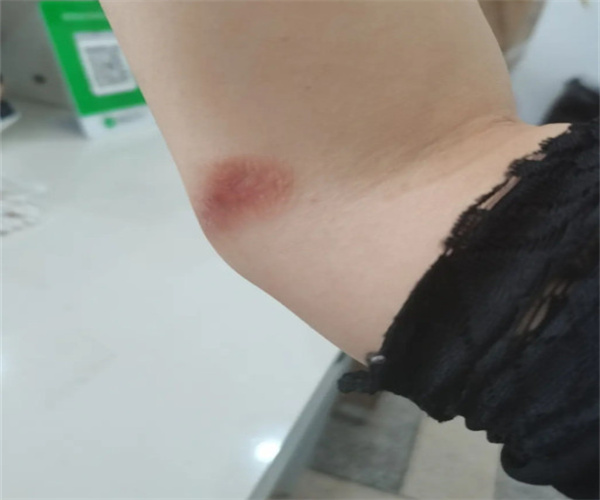 和美疤痕修复加盟费用