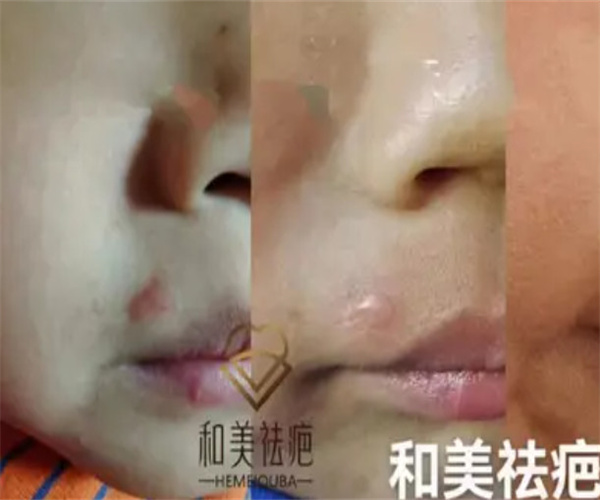 和美疤痕修复加盟费用