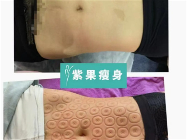 紫果瘦身加盟费