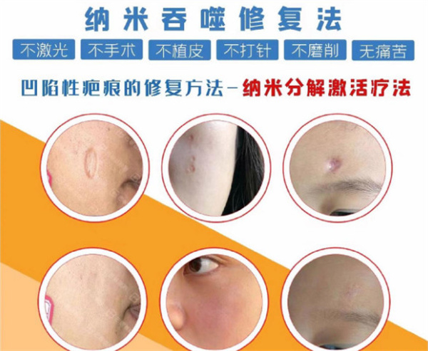 巴敏荟除疤加盟费