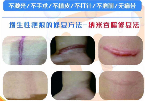 巴敏荟除疤加盟费