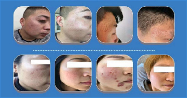 巴敏荟除疤加盟费